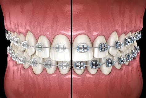 metal brackets vs ceramic brackets|ceramic ortho brackets.